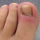 UNHAS ENCRAVADAS