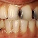 User_dentes  com cárie