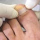 Unhas Encravadas e Cravos